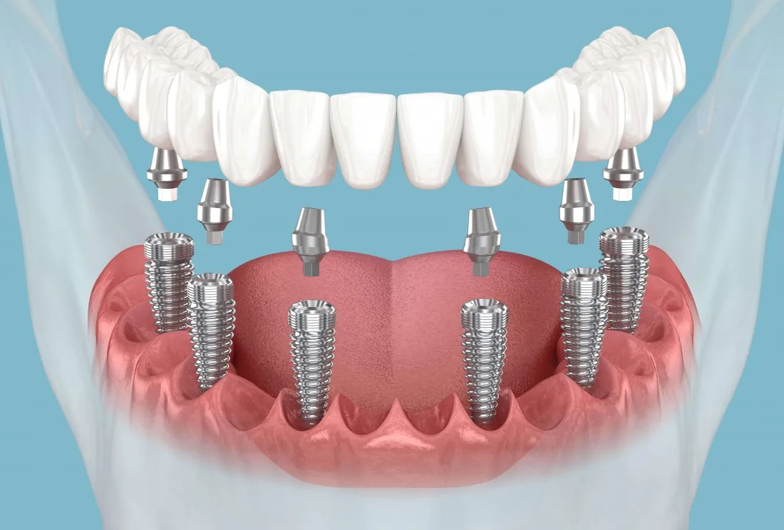 dental implants dentures