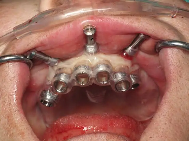 implant surgery