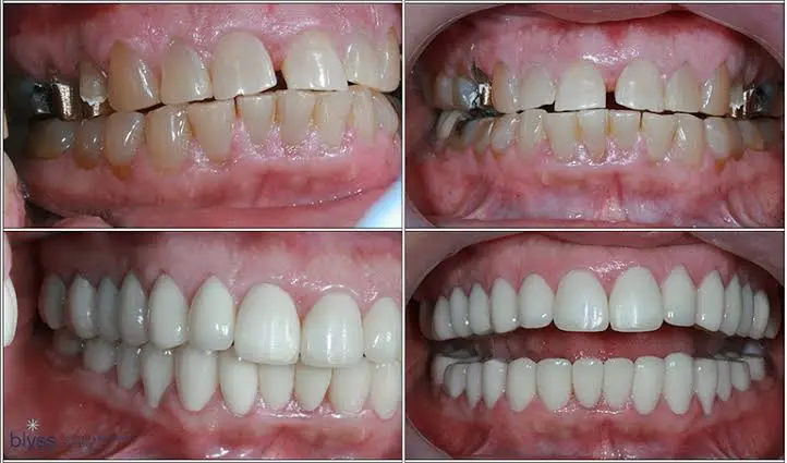 teeth reconstruction